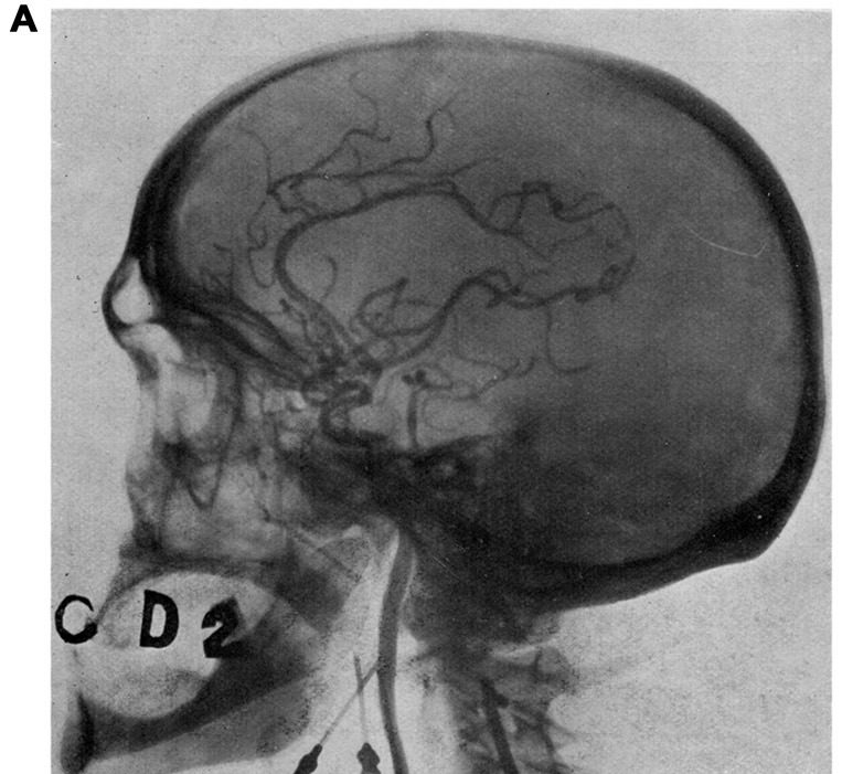 Carotid angiogram, Moniz, 1927